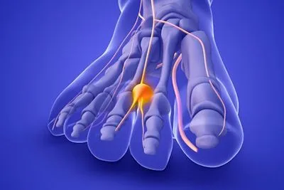 Neuroma