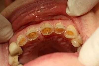 Worn Teeth Due to Bruxism