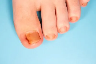 Ingrown Toenails