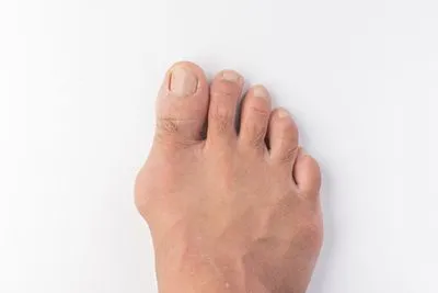 Bunions-in-Pomona-and-Tappan-NY