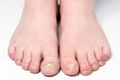 Foot-heavily-infected-of-fungus-toenail-in-the-white-floor.