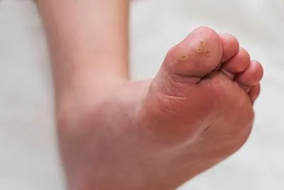 Plantar-Warts-Treatment-in-Lockport-or-Williamsville-NY
