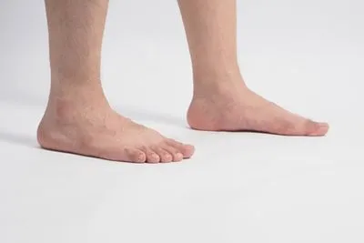 Flat-Feet-Treatment-in-Williamsville-and-Lockport-NY