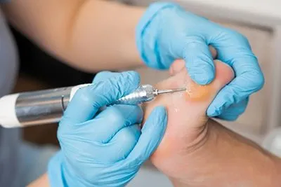 Callus-Removal-in-Williamsville-and-Lockport-NY