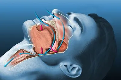 Illustration of Sleep Apnea