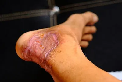 Close-up of foot wound healing post biological grafting