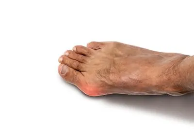 Foot with bunion deformity (hallux valgus) close-up