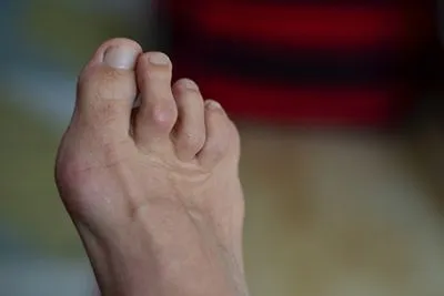 Close-up view of foot showing hammertoe deformity