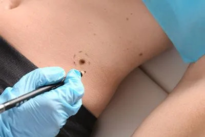 Dermatologist identifying and marking a skin cancer lesion for treatment