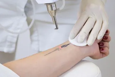 Laser-Tattoo-Removal-in-Bloomington-Bedford-and-New-Whiteland-IN