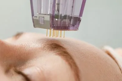 Close-up of microneedling on a woman’s forehead
