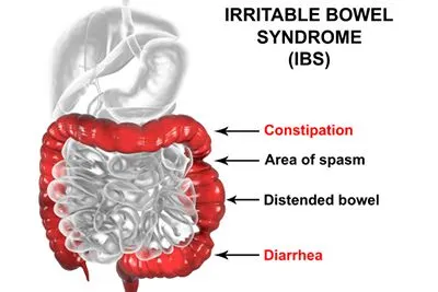 IBS-Treatment-in-Lawrence-NY