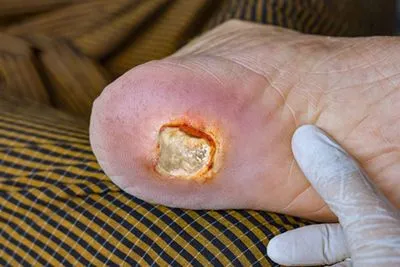 Detailed view of a heel showing an arterial ulcer.