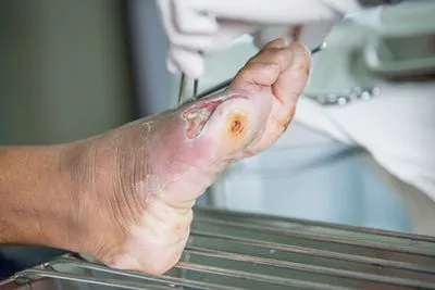 Podiatrist treating patient’s foot infection
