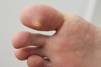 Plantar Warts in Harrison & Mountain Home, AR