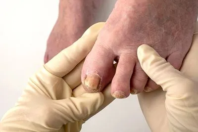 Toenail Fungus on a persons foot