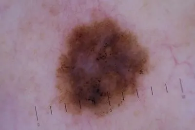 Detailed close-up image of melanoma on the skin