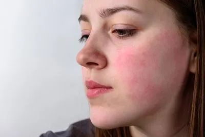 rosacea treatment in hemet and murrieta ca