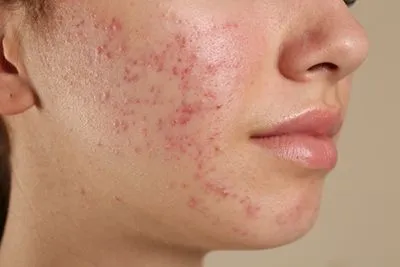 Woman with active acne and skin inflammation on cheek