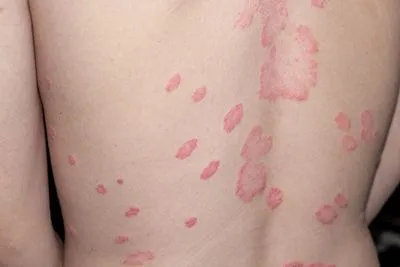 Man with psoriasis patches on back