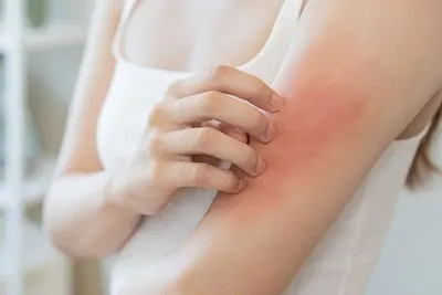 Woman experiencing itchy skin rash on upper arm due to possible allergic reaction or dermatitis