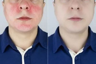 Comparison of facial rosacea before and after pulsed dye laser treatment