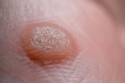 Close-up view of warts on skin surface for dermatological reference