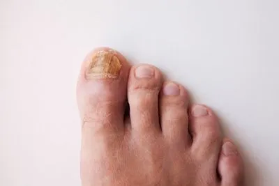 Toenail Fungus