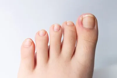 Ingrown Toenail Treatment in McKinney, TX and Prosper, TX