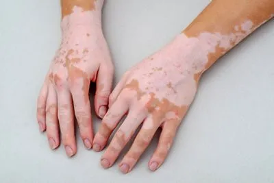 Hands with visible white patches due to vitiligo.