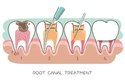 Illustration Of Root Canal Process, Brownsville, TX