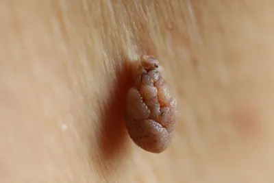 Zoomed-in view of small skin tag on body surface.