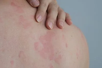 Person suffering from allergy on skin