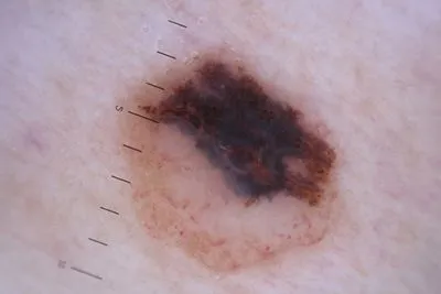 Illustration of Melanoma on skin