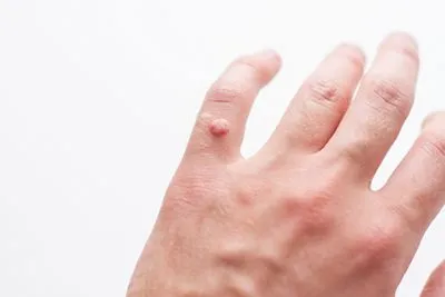 Person with wart in hand.