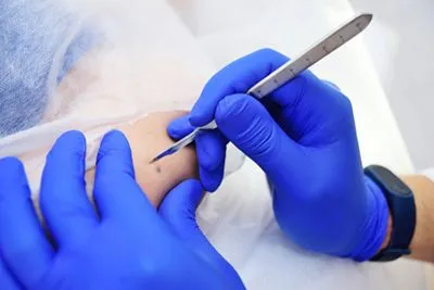 Dermatologist during mole removal procedure