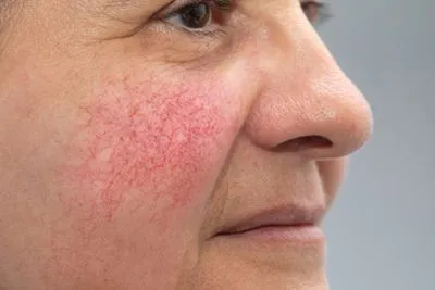 Side profile of a woman with facial rosacea