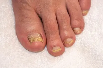 Fungal-Toenail