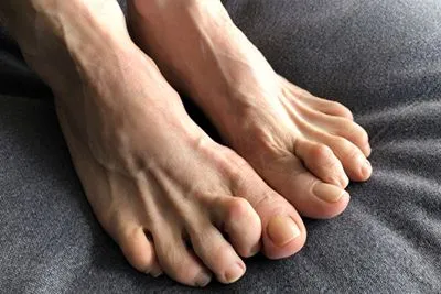 Hammertoes