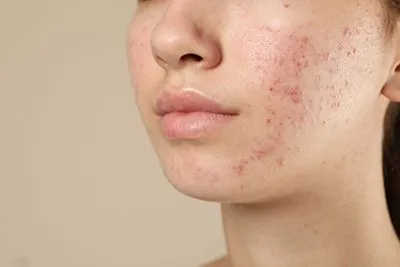 Close-up of a woman’s cheek showing inflamed acne.
