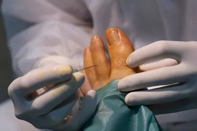 Illustration of Minimally Invasive Foot Surgery