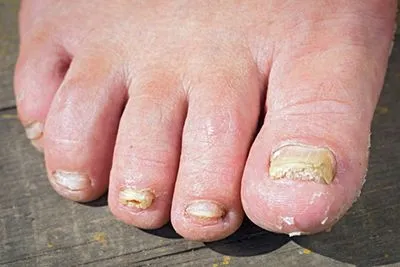 Toenail Fungus