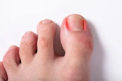 Ingrown Toenails