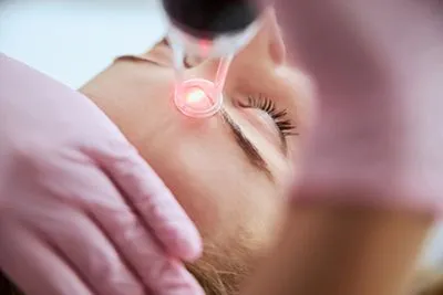 AviClear® laser treatment procedure