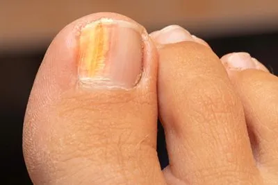 Toenail-Fungus-Treatment-in-Norridge-IL