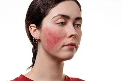 Rosacea