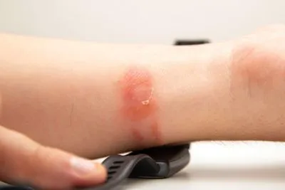 Contact-Dermatitis-Treatment-in-Vienna-VA