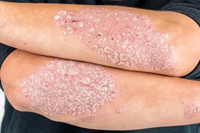 Psoriasis