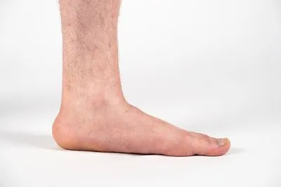 Flat-Feet