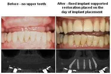Before And After Implant Denture pics from Alexander Pritsky, DMD in Fresno, CA